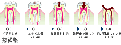 虫歯の進み方と治療法