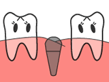 インプラント