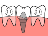 インプラント