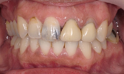 施術前の口腔写真